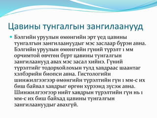 Цавины тунгалгын зангилаанууд
 Бэлгийн уруулын өмөнгийн эрт үед цавины
тунгалгын зангилаануудыг мэс заслаар бүрэн авна.
Бэлгийн уруулын өмөнгийн гүний түрэлт 1 мм
орчимтой өвчтөн бүрт цавины тунгалгын
зангилаанууд авах мэс засал хийнэ. Гүний
түрэлтийг тодорхойлохын тулд хавдраас шаантаг
хэлбэрийн биопси авна. Гистологийн
шинжилгээгээр өмөнгийн түрэлтийн гүн 1 мм-с их
биш байвал хавдрыг өргөн хүрээнд зүсэж авна.
Шинжилгээгээр нийт хавдрын түрэлтийн гүн нь 1
мм-с их биш байхад цавины тунгалгын
зангилаануудыг авахгүй.
 
