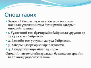 Онош тавих
 Хонэний боловсруулсан шалгуурт тохирсон
нөхцөлд үүдэвчний том булчирхайн хавдрын
оношийг тавина.
 1. Үүдэвчний том булчирхайн байршилд уруулын ар
хажуу хэсэгт байрласан.
 2. Бэлгийн том уруулын дагууд байрласан.
 3. Хавдрын дээрх арьс өөрчлөгдөөгүй.
 4. Хавдарт булчирхайлаг эд илрэх
Оношийг гистологийн зураглал ба хавдрын ердийн
байршилд үндэслэж тавина.
 