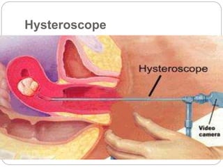 Hysteroscope
 