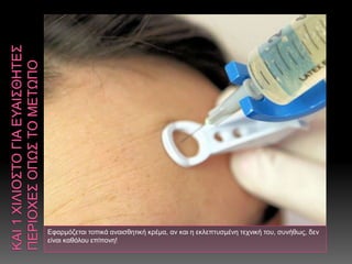 Εφαρμόζεται τοπικά αναισθητική κρέμα, αν και η εκλεπτυσμένη τεχνική του, συνήθως, δεν
είναι καθόλου επίπονη!
 