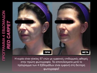 Η κυρία είναι ηλικίας 57 ετών με εμφανείς επιδερμικές φθορές
στην πρώτη φωτογραφία. Τα αποτελέσματα μετά το
πρόγραμμα των 4 Εβδομάδων είναι εμφανή στη δεύτερη
φωτογραφία!
 