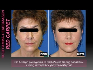 Στη δεύτερη φωτογραφία τα 63 βιολογικά έτη της παραπάνω
κυρίας, σίγουρα δεν γίνονται αντιληπτα!
 