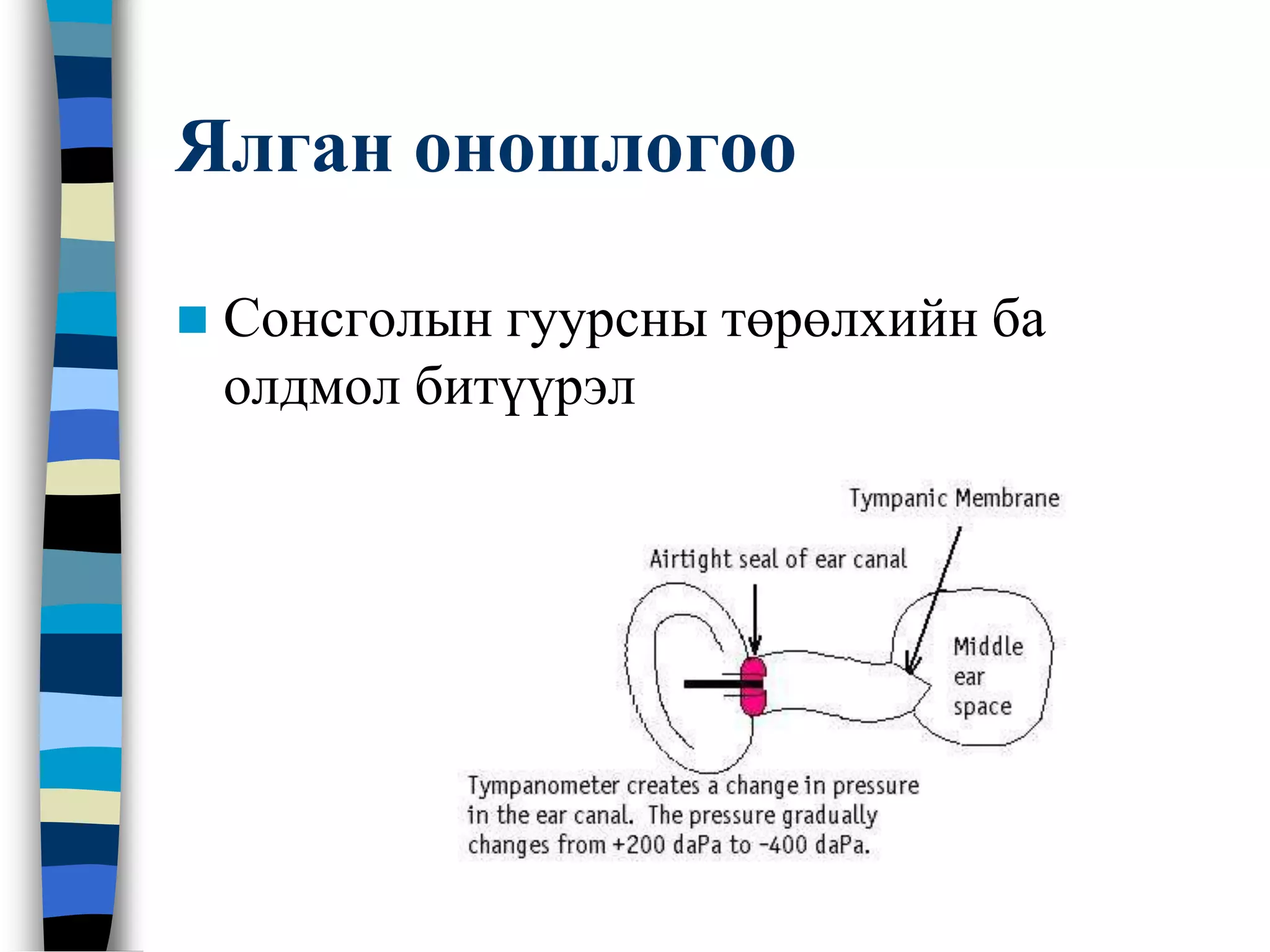 Дунд чихний архаг үрэвсэл | PPT