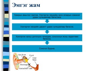 Эмгэг жам
Сонсгол буурна.
Хэнгэргэн хальс дотогшоо татагдаж, сонсголын ясны хөдөлгөөн
багасна.
Хэнгэргэн хөндийн даралт удаан хугацаагаар багасна.
Хамрын амьсгал саатаж. Хэнгэргэн хөндийд орох агаарын хэмжээг
удаан хугацаагаар багасгана.
 