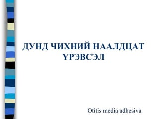 ДУНД ЧИХНИЙ НААЛДЦАТ
ҮРЭВСЭЛ
Otitis media adhesiva
 