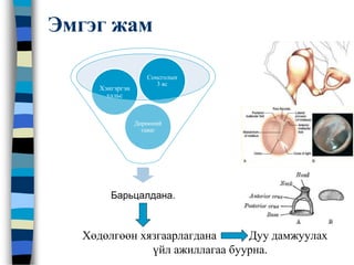 Хөдөлгөөн хязгаарлагдана Дуу дамжуулах
үйл ажиллагаа буурна.
Барьцалдана.
Дөрөөний
таваг
Хэнгэргэн
хальс
Сонсголын
3 яс
Эмгэг жам
 
