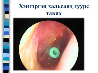 Хэнгэргэн хальсанд гуурс
тавих
 