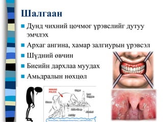 Шалгаан
 Дунд чихний цочмог үрэвслийг дутуу
эмчлэх
 Архаг ангина, хамар залгиурын үрэвсэл
 Шүдний өвчин
 Биеийн дархлаа муудах
 Амьдралын нөхцөл
 