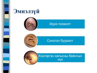 Эмнэлзүй
Идээ гоожилт
Сонсгол бууралт
Хэнгэргэн хальсны байнгын
нүх
 