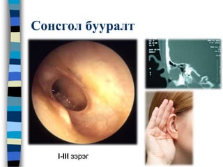 Сонсгол бууралт
I-III зэрэг
 