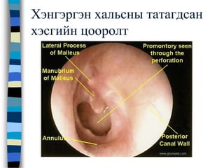 Хэнгэргэн хальсны татагдсан
хэсгийн цооролт
 