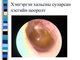 Хэнгэргэн хальсны суларсан
хэсгийн цооролт
 