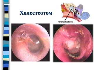 Холестеотом
 