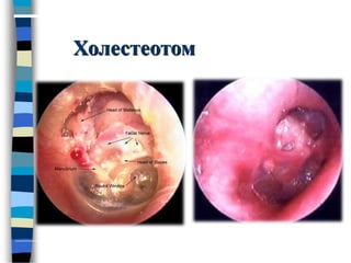 Холестеотом
 