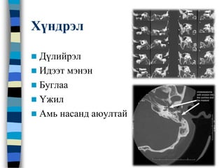 Хүндрэл
 Дүлийрэл
 Идээт мэнэн
 Буглаа
 Үжил
 Амь насанд аюултай
 