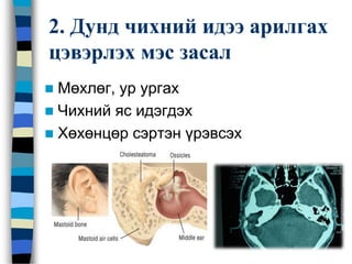 2. Дунд чихний идээ арилгах
цэвэрлэх мэс засал
 Мөхлөг, ур ургах
 Чихний яс идэгдэх
 Хөхөнцөр сэртэн үрэвсэх
 