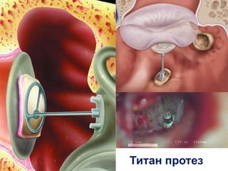 Титан протез
 