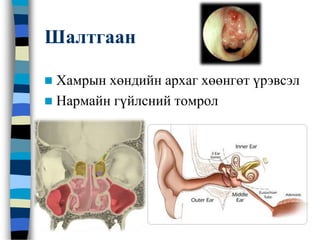 Шалтгаан
 Хамрын хөндийн архаг хөөнгөт үрэвсэл
 Нармайн гүйлсний томрол
 