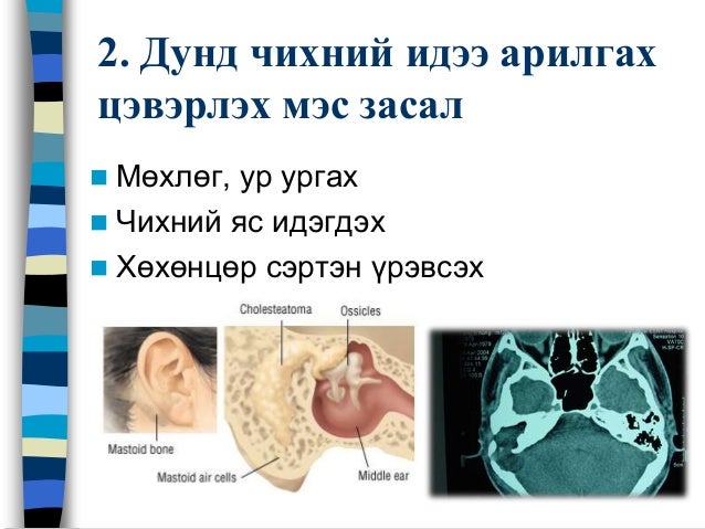 Дунд чихний архаг үрэвсэл