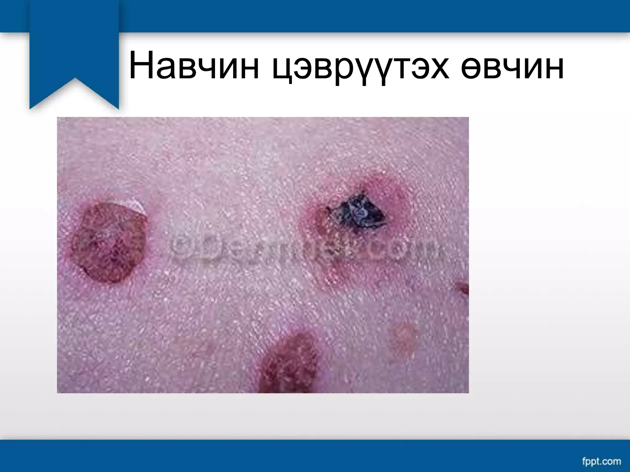 Цэврүүт өвчинүүд | PPT