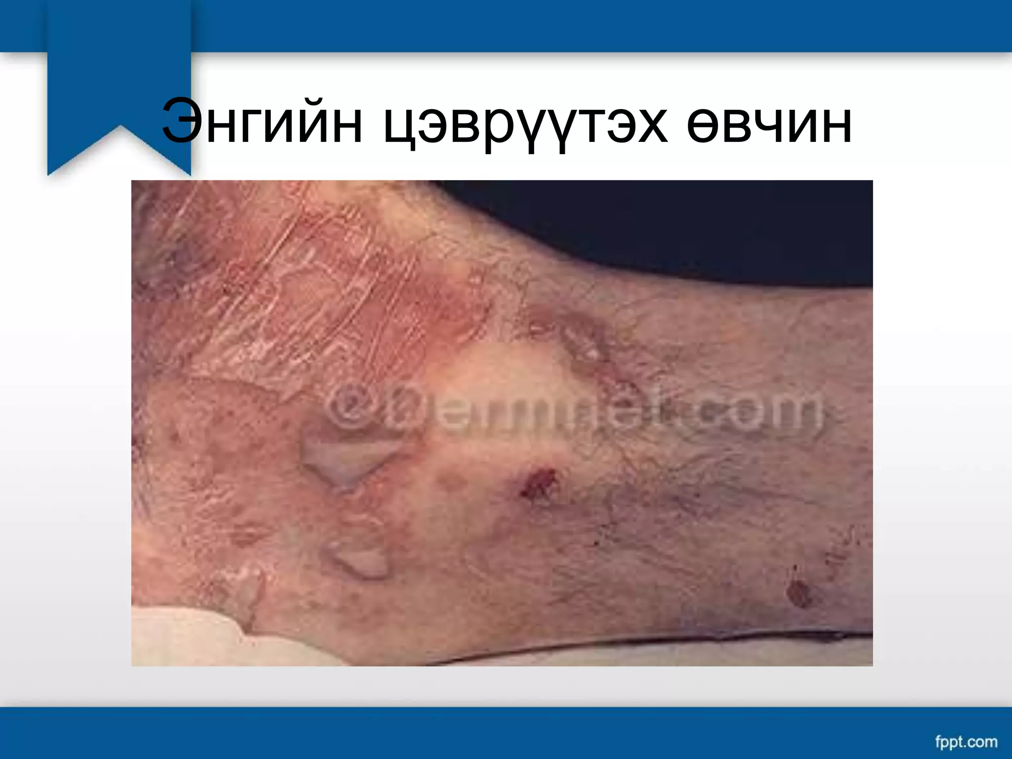 Цэврүүт өвчинүүд | PPT
