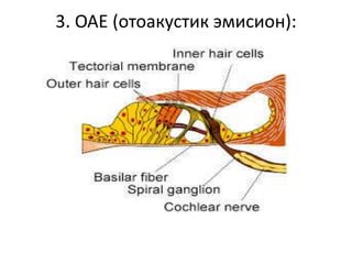 3. ОАЕ (отоакустик эмисион):
 