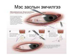 хялар өвчин | PPT