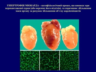 ГІПЕРТРОФІЯ МІОКАРДА – патофізіологічний процес, що виникає при
перевантаженні серця (або окремих його відділів), та спричинює збільшення
маси органу за рахунок збільшення об`єму кардіоміоцитів
 