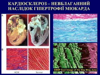 КАРДІОСКЛЕРОЗ – НЕВБЛАГАННИЙ
НАСЛІДОК ГІПЕРТРОФІЇ МІОКАРДА
 