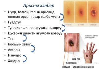 Арьсны хэлбэр
• Нүүр, толгой, гарын арьсанд
нянгын орсон газар толбо үүснэ
• Гүвдрүү
• Тунгалаг шингэн агуулсан цэврүү
• Цусархаг шингэн агуулсан цэврүү
• Тав
• Боомын хатиг
• Anthrax
• Нэвчдэс
• Хавдар
Хар тав
Хормойвч
Хавдар Стефанскийн шинж
 