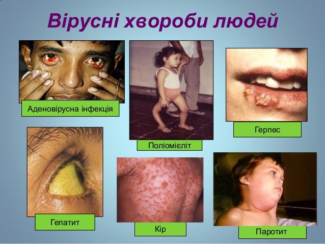 Вірусні хвороби людей
Кір
Поліомієліт
Гепатит
Аденовірусна інфекція
Паротит
Герпес
 