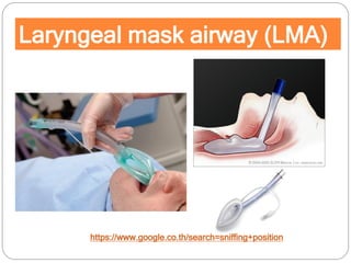 Laryngeal mask airway (LMA)
https://www.google.co.th/search=sniffing+position
 