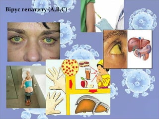 Вірус гепатиту (А,В,С)
 