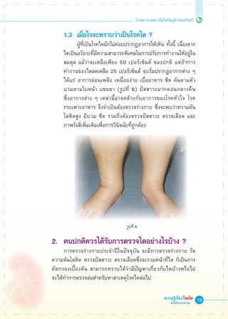 15
โรงพยาบาลสถาบันโรคไตภูมิราชนครินทร์
ความรู้เรื่องโรคไต
สำหรับประชาชน
	 1.3 	เมื่อไรจะทราบว่าเป็นโรคไต ?
			 ผู้ที่เป็นโรคไตมักไม่ค่อยปรากฏอาการให้เห็น ทั้งนี้ เนื่องจาก

	 ไตเป็นอวัยวะที่มีความสามารถพิเศษในการปรับการทำงานให้อยู่ใน

	 สมดุล แม้ว่าจะเหลือเพียง 50 เปอร์เซ็นต์ ของปกติ แต่ถ้าการ

	 ทำงานของไตลดเหลือ 25 เปอร์เซ็นต์ จะเริ่มปรากฏอาการต่าง ๆ 

	 ได้แก่ อาการอ่อนเพลีย เหนื่อยง่าย เบื่ออาหาร ซีด คันตามตัว 

	 บวมตามใบหน้า แขนขา (รูปที่ 6) ปัสสาวะมากตอนกลางคืน 

	 ซึ่งอาการต่าง ๆ เหล่านี้อาจคล้ายกับอาการของโรคหัวใจ โรค

	 กระเพาะอาหาร จึงจำเป็นต้องตรวจร่างกาย ซึ่งจะพบว่าความดัน

	 โลหิตสูง มีบวม ซีด รวมถึงต้องตรวจปัสสาวะ ตรวจเลือด และ

	 ภาพรังสีเพิ่มเติมเพื่อการวินิจฉัยที่ถูกต้อง












2.	 คนปกติควรได้รับการตรวจไตอย่างไรบ้าง ?
	 การตรวจร่างกายประจำปีในปัจจุบัน จะมีการตรวจร่างกาย วัด
ความดันโลหิต ตรวจปัสสาวะ ตรวจเลือดซึ่งจะรวมหน้าที่ไต ก็เป็นการ
คัดกรองเบื้องต้น สามารถทราบได้ว่ามีปัญหาเกี่ยวกับไตบ้างหรือไม่ 

จะได้ทำการตรวจต่อสำหรับหาสาเหตุโรคไตต่อไป
 