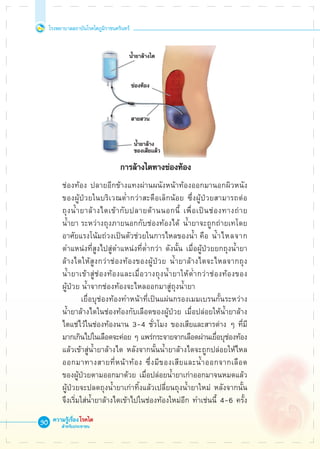 โรงพยาบาลสถาบันโรคไตภูมิราชนครินทร์
ความรู้เรื่องโรคไต
สำหรับประชาชน
30











	 ช่องท้อง ปลายอีกข้างแทงผ่านผนังหน้าท้องออกมานอกผิวหนัง

	 ของผู้ป่วยในบริเวณต่ำกว่าสะดือเล็กน้อย ซึ่งผู้ป่วยสามารถต่อ

	 ถุงน้ำยาล้างไตเข้ากับปลายด้านนอกนี้ เพื่อเป็นช่องทางถ่าย

	 น้ำยา	ระหว่างถุงภายนอกกับช่องท้องได้ น้ำยาจะถูกถ่ายเทโดย

	 อาศัยแรงโน้มถ่วงเป็นตัวช่วยในการไหลของน้ำ คือ	น้ำไหลจาก

	 ตำแหน่งที่สูงไปสู่ตำแหน่งที่ต่ำกว่า ดังนั้น เมื่อผู้ป่วยยกถุงน้ำยา

	 ล้างไตให้สูงกว่าช่องท้องของผู้ป่วย น้ำยาล้างไตจะไหลจากถุง

	 น้ำยาเข้าสู่ช่องท้องและเมื่อวางถุงน้ำยาให้ต่ำกว่าช่องท้องของ

	 ผู้ป่วย น้ำจากช่องท้องจะไหลออกมาสู่ถุงน้ำยา
			 เยื่อบุช่องท้องทำหน้าที่เป็นแผ่นกรองเมมเบรนกั้นระหว่าง

	 น้ำยาล้างไตในช่องท้องกับเลือดของผู้ป่วย เมื่อปล่อยให้น้ำยาล้าง

	 ไตแช่ไว้ในช่องท้องนาน 3-4 ชั่วโมง ของเสียและสารต่าง ๆ ที่มี

	 มากเกินไปในเลือดจะค่อย ๆ แพร่กระจายจากเลือดผ่านเยื่อบุช่องท้อง 

	 แล้วเข้าสู่น้ำยาล้างไต หลังจากนั้นน้ำยาล้างไตจะถูกปล่อยให้ไหล 

	 ออกมาทางสายที่หน้าท้อง ซึ่งมีของเสียและน้ำออกจากเลือด

	 ของผู้ป่วยตามออกมาด้วย เมื่อปล่อยน้ำยาเก่าออกมาจนหมดแล้ว 

	 ผู้ป่วยจะปลดถุงน้ำยาเก่าทิ้งแล้วเปลี่ยนถุงน้ำยาใหม่ หลังจากนั้น

	 จึงเริ่มใส่น้ำยาล้างไตเข้าไปในช่องท้องใหม่อีก ทำเช่นนี้ 4-6 ครั้ง

 