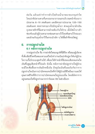 31
โรงพยาบาลสถาบันโรคไตภูมิราชนครินทร์
ความรู้เรื่องโรคไต
สำหรับประชาชน
	 ต่อวัน แล้วแต่ว่าทำการล้างไตด้วยน้ำยาขนาดบรรจุเท่าใด 

	 โดยปกติปลายสายที่แทงออกมาภายนอกบริเวณหน้าท้องยาว

	 ประมาณ 6-10 เซนติเมตร และมีสายยาวประมาณ 120-150 

	 เซนติเมตร ต่อจากสายยางไปยังถุงน้ำยา ส่วนถุงน้ำยามักเป็น

	 ถุงพลาสติกที่นิ่มสามารถม้วนพับเก็บได้ง่าย เมื่อใส่น้ำยาเข้า

	 ช่องท้องแล้วผู้ป่วยสามารถซ่อนสายยางไว้โดยพันสายไว้รอบเอว

	 และม้วนเก็บถุงน้ำยาไว้ในกระเป๋าเล็ก ๆ ใต้เสื้อผ้าที่สวมใส่อยู่ 

6.	 การปลูกถ่ายไต
	 6.1 หลักการปลูกถ่ายไต
	 การปลูกถ่ายไต คือ การผ่าตัดไตของญาติที่มีชีวิต หรือของผู้บริจาค
ที่เพิ่งเสียชีวิตหรือสมองตายแต่ไตยังทำงานเป็นปกติอยู่มาให้แก่ผู้ป่วย
ไตวายเรื้อรังระยะสุดท้ายใช้ เพื่อจะได้ทำหน้าที่ขับของเสียทดแทนไต
เดิมซึ่งสูญเสียหน้าที่ไปแล้ว ดังนั้น หลังการผ่าตัดปลูกถ่ายไตผู้ป่วย

จะมีไตเพิ่มขึ้นจากเดิมอีกหนึ่งอัน ปัจจุบันเป็นที่ยอมรับกันว่าการ

ปลูกถ่ายไตเป็นการบำบัดทดแทนไตที่ทำให้ผู้ป่วยมีชีวิตยืนยาวและให้
คุณภาพชีวิตที่ดีกว่าการบำบัดทดแทนไตรูปแบบอื่น โดยมีอัตราการ

อยู่รอดของไตที่ปลูกถ่ายมากกว่าร้อยละ 95 ในช่วงปีแรก










 