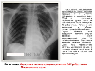 На обзорной рентгенограмме
органов грудной клетки в прямой
проекции от в условиях
реанимации, в положении сидя,
08:35 – определяется
деформация грудной клетки за
счет состояния после резекции 6-
12 ребер слева. Легочное поле
уменьшено в объеме,
паракостально свободный воздух.
Справа легочные поля
воздушные, легочной рисунок
сохранен. Корни
малоструктурные, четко не
дифференцируются. Тень сердца
занимает типичное положение.
Слева тень подключичного
катетера, дистальным концом в
проекции верхней полой вены. В
левой плевральной полости тени
дренажных трубок.
Заключение: Состояния после операции – резекции 6-12 ребер слева.
Пневмоторакс слева.
 