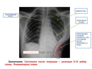 Заключение: Состояния после операции – резекции 6-12 ребер
слева. Пневмоторакс слева.
 