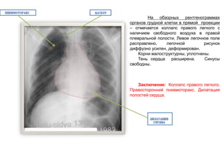 На обзорных рентгенограммах
органов грудной клетки в прямой проекции
– отмечается коллапс правого легкого с
наличием свободного воздуха в правой
плевральной полости. Левое легочное поле
расправлено, легочной рисунок
диффузно усилен, деформирован.
Корни малоструктурны, уплотнены.
Тень сердца расширена. Синусы
свободны.
Заключение: Коллапс правого легкого.
Правосторонний пневмоторакс. Дилатация
полостей сердца.
 