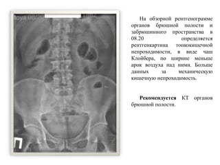 На обзорной рентгенограмме
органов брюшной полости и
забрюшинного пространства в
08.20 определяется
рентгенкартина тонкокишечной
непроходимости, в виде чаш
Клойбера, по ширине меньше
арок воздуха над ними. Больше
данных за механическую
кишечную непроходимость.
Рекомендуется КТ органов
брюшной полости.
 