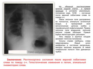На обзорной рентгенограмме
органов грудной клетки в прямой
проекции в условиях реанимации,
положении сидя, 13/30 – состояние
после верхней лобэктомии слева по
поводу с-ч.
Левое легочное поле расправлено
не полностью, апикально остаточный
воздух, в прикорневой зоне
металлическая цепочка скобок с
перифокальной инфильтрацией. Правое
легочное поле воздушное, легочной
рисунок справа обогащен. Правый
корень малоструктурен, расширен.
Тень сердца и крупных сосудов
занимает типичное положение.
Синусы справа свободны, слева
завуалированы. Левый купол
диафрагмы в состоянии релаксации,
желудок заполнен воздухом. В левой
плевральной полости тени дренажных
трубок.
Заключение: Рентгенкартина состояния после верхней лобэктомии
слева по поводу с-ч. Гипостатические изменения в легких, апикальный
пневмоторакс слева.
 