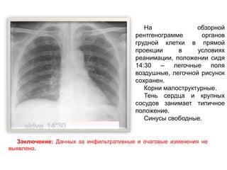 На обзорной
рентгенограмме органов
грудной клетки в прямой
проекции в условиях
реанимации, положении сидя
14:30 – легочные поля
воздушные, легочной рисунок
сохранен.
Корни малоструктурные.
Тень сердца и крупных
сосудов занимает типичное
положение.
Синусы свободные.
Заключение: Данных за инфильтративные и очаговые изменения не
выявлено.
 