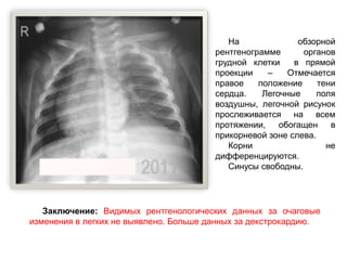 На обзорной
рентгенограмме органов
грудной клетки в прямой
проекции – Отмечается
правое положение тени
сердца. Легочные поля
воздушны, легочной рисунок
прослеживается на всем
протяжении, обогащен в
прикорневой зоне слева.
Корни не
дифференцируются.
Синусы свободны.
Заключение: Видимых рентгенологических данных за очаговые
изменения в легких не выявлено. Больше данных за декстрокардию.
 