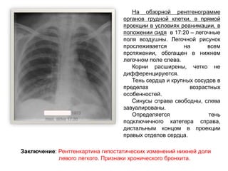 На обзорной рентгенограмме
органов грудной клетки, в прямой
проекции в условиях реанимации, в
положении сидя в 17:20 – легочные
поля воздушны. Легочной рисунок
прослеживается на всем
протяжении, обогащен в нижнем
легочном поле слева.
Корни расширены, четко не
дифференцируются.
Тень сердца и крупных сосудов в
пределах возрастных
особенностей.
Синусы справа свободны, слева
завуалированы.
Определяется тень
подключичного катетера справа,
дистальным концом в проекции
правых отделов сердца.
Заключение: Рентгенкартина гипостатических изменений нижней доли
левого легкого. Признаки хронического бронхита.
 