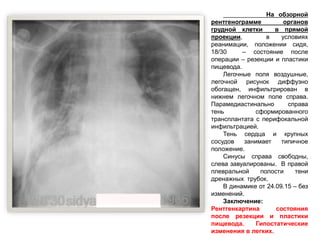 На обзорной
рентгенограмме органов
грудной клетки в прямой
проекции, в условиях
реанимации, положении сидя,
18/30 – состояние после
операции – резекции и пластики
пищевода.
Легочные поля воздушные,
легочной рисунок диффузно
обогащен, инфильтрирован в
нижнем легочном поле справа.
Парамедиастинально справа
тень сформированного
трансплантата с перифокальной
инфильтрацией.
Тень сердца и крупных
сосудов занимает типичное
положение.
Синусы справа свободны,
слева завуалированы. В правой
плевральной полости тени
дренажных трубок.
В динамике от 24.09.15 – без
изменений.
Заключение:
Рентгенкартина состояния
после резекции и пластики
пищевода. Гипостатические
изменения в легких.
 