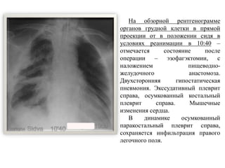 На обзорной рентгенограмме
органов грудной клетки в прямой
проекции от в положении сидя в
условиях реанимации в 10:40 –
отмечается состояние после
операции – эзофагэктомии, с
наложением пищеводно-
желудочного анастомоза.
Двухсторонняя гипостатическая
пневмония. Экссудативный плеврит
справа, осумкованный костальный
плеврит справа. Мышечные
изменения сердца.
В динамике осумкованный
паракостальный плеврит справа,
сохраняется инфильтрация правого
легочного поля.
 