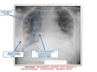 Заключение: Рентгенкартина состояния после резекции и
пластики пищевода. Гипостатические изменения в легких.
 