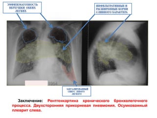 Заключение: Рентгенкартина хронического бронхолегочного
процесса. Двухсторонняя прикорневая пневмония. Осумкованный
плеврит слева.
 