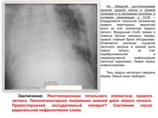 На обзорной рентгенограмме
органов грудной клетки в прямой
проекции от в положении полулежа в
условиях реанимации в 14.05 –
определяется тотальное затемнение
правого гемиторакса, вероятнее
всего за счет ателектаза правого
легкого. Воздушный столб трахеи и
главные бронхи смещены вправо,
правый главный бронх обтурирован.
Отмечается усиление сгущение
легочного рисунка в нижней доле
левого легкого, за счет
перибронхиальной и
периваскулярной инфильтрации
легочной паренхимы. Левый корень
инфильтрирован.
Тень сердца несколько смещена
вправо. Левый синус свободен.
Заключение: Рентгенпризнаки тотального ателектаза правого
легкого. Полисегментарная пневмония нижней доли левого легкого.
Правосторонний экссудативный плеврит? Состояние после
радикальной нефроэктомии слева.
 