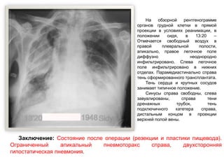 На обзорной рентгенограмме
органов грудной клетки в прямой
проекции в условиях реанимации, в
положении сидя, в 13:20 –
Отмечается свободный воздух в
правой плевральной полости,
апикально, правое легочное поле
диффузно неоднородно
инфильтрировано. Слева легочное
поле инфильтрировано в нижних
отделах. Парамедиастинально справа
тень сформированного трансплантата.
Тень сердца и крупных сосудов
занимает типичное положение.
Синусы справа свободны, слева
завуалированы, справа тени
дренажных трубок, тень
подключичного катетера справа,
дистальным концом в проекции
верхней полой вены.
Заключение: Состояние после операции (резекции и пластики пищевода).
Ограниченный апикальный пневмоторакс справа, двухсторонняя
гипостатическая пневмония.
 